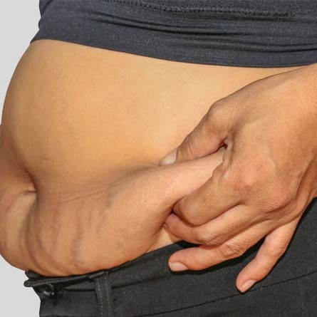 درمان های طبیعی برای افتادگی پوست شکم بعد از زایمان
