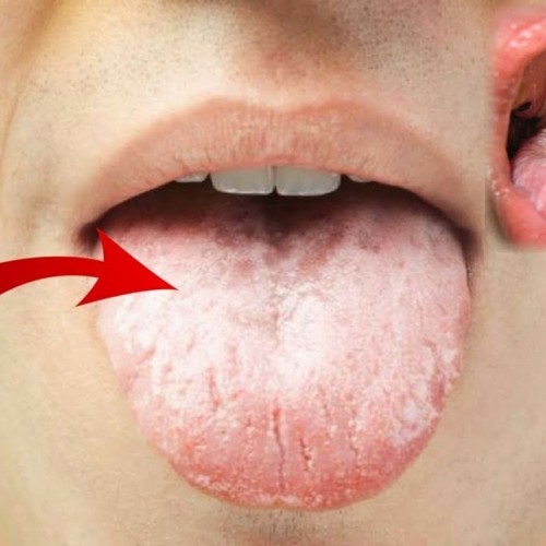 درمان برفک دهان به چند روش