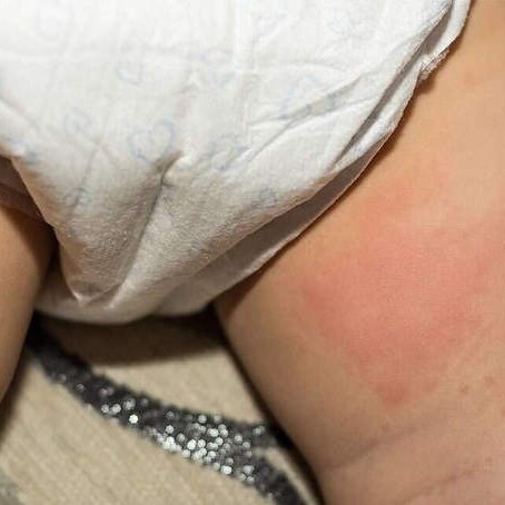 درمان خانگی التهاب پوشکی بچه
