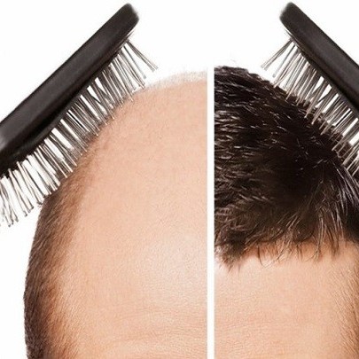 درمان ریزش مو در مردان به روش طب سنتی 