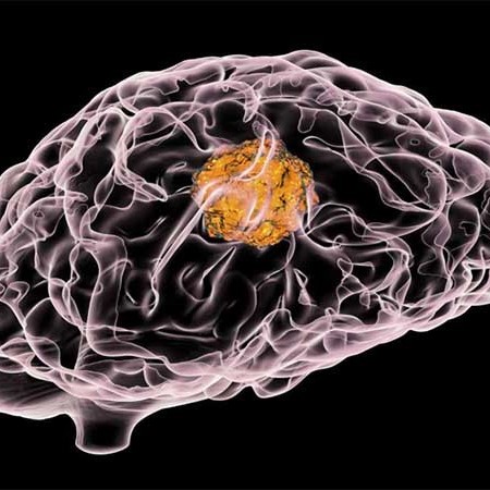 درمان تومورهای مغزی چیست؟