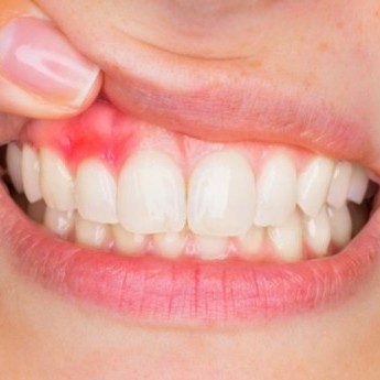 دلایل آبسه دندان در بارداری و روش های درمان