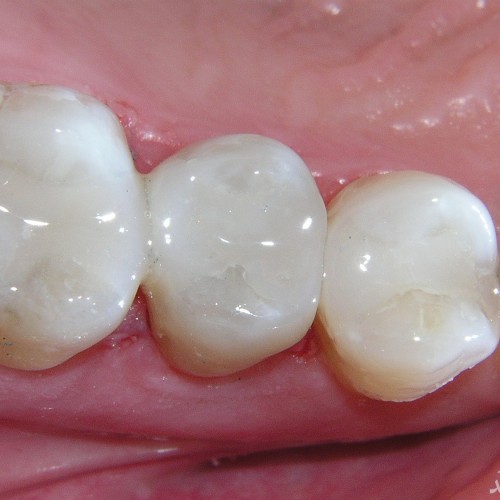 در مورد پر کردن دندان با مواد همرنگ چه می دانید؟
