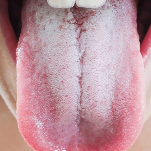 چه کسانی به برفک دهان مبتلا می‌شوند و علت آن چیست؟