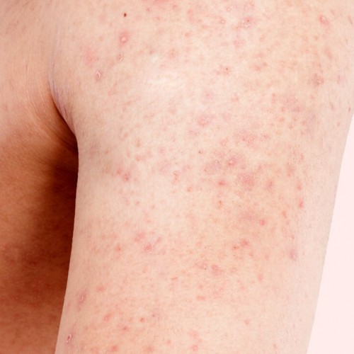 علل شایع به وجود آمدن جوش روی بازو