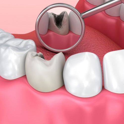 فرایند پر کردن دندان چگونه است و مراقبت‌های پس از آن