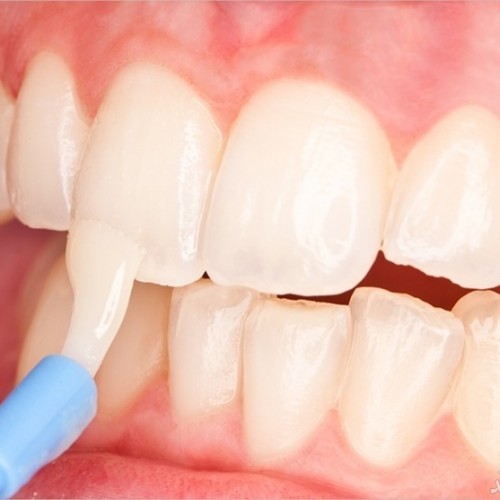 هدف و کاربرد لمینت های سرامیکی دندان چیست؟