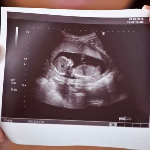 همه چیز درباره سونوگرافی تعیین جنسیت جنین