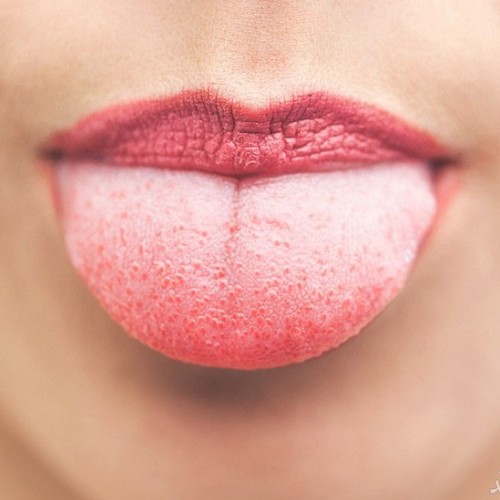 جوش روی زبان می تواند نشان دهنده ی سرطان باشد؟