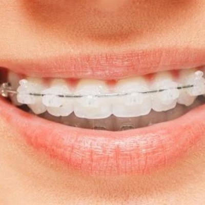 نحوه کشیدن نخ دندان برای بیماران ارتودنسی
