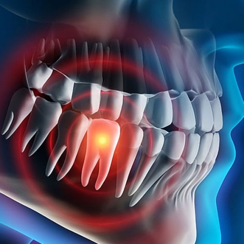 خطرات دندان عفونی