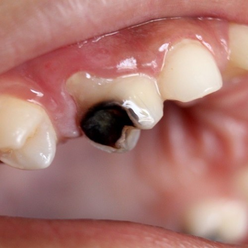 خطرات و عوارض عصب ‌کشی دندان در دوران بارداری