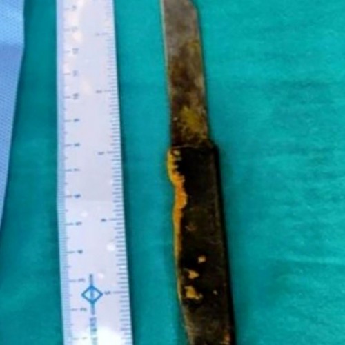 خروج چاقوی ۲۰ سانتی از کبد مرد هندی جراحان را شگفت‌ زده کرد