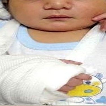 ماجرای جنجالی تولد نوزاد خرمشهری با دست شکسته