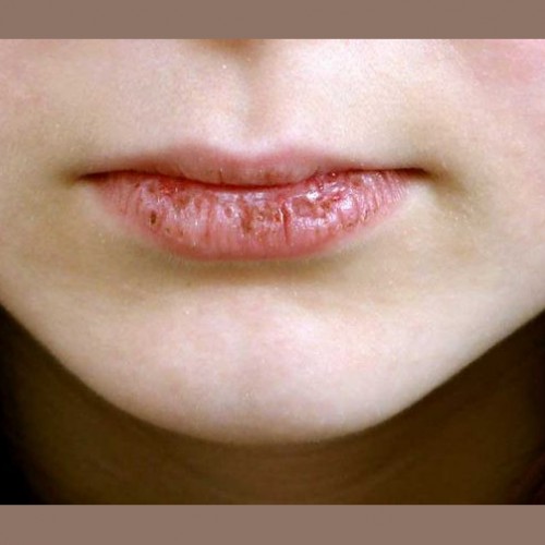 منظو از بیماری خشکی دهان چیست؟