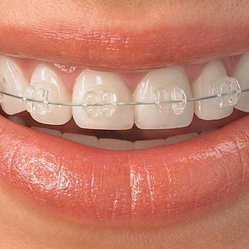 مزیت‌ها و معایب اینویزالاین در دندان پزشکی