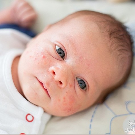 میلیا یا لکه های شیری در نوزادان