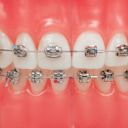 مهمترین مراحل ارتودنسی ثابت چیست؟