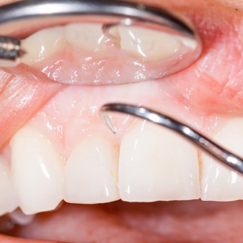پر کننده های غیر مستقیم دندان