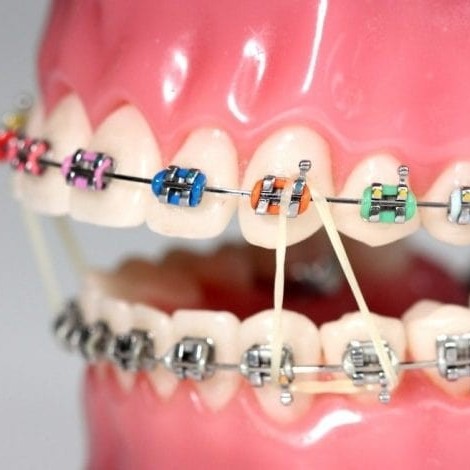 رفع فاصله بین دندان‌ها بدون ارتودنسی امکان پذیر است؟
