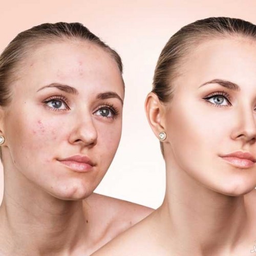 راه های جلوگیری از جوش زدن بعد از بند انداختن