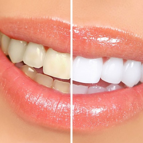 روش سفید شدن دندان های سیاه