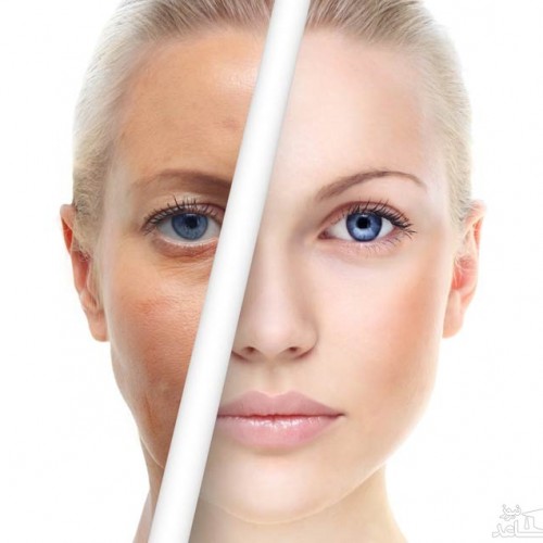 سوالات متداول در مورد تزریق نانو چربی