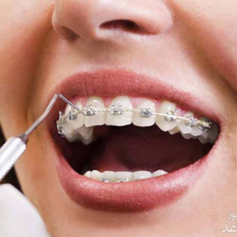 تکنیک هایی برای تسکین درد دندان های ارتودنسی شده