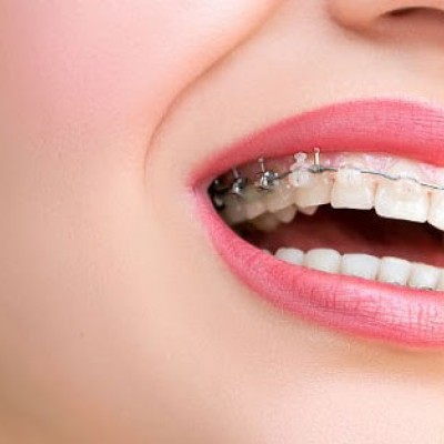پیشگیری از لکه دار شدن دندان‌ها حین استفاده از بریس