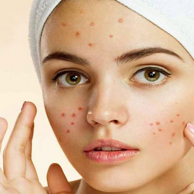 جوش صورت/منافذ پوست بعد از شیو (دون دون شدن پوست)