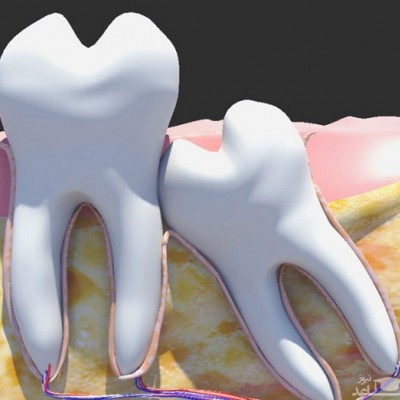 ایا دندان عقل باعث نامرتبی دندان ها میشود؟