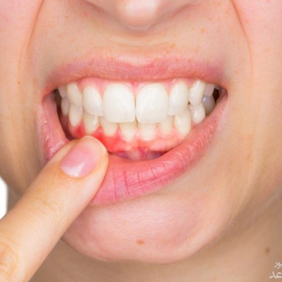 علل عفونت و آبسه دندان و راههای درمان آن