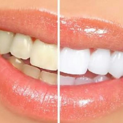 دانستن نکاتی مهم درباره ی جرم گیری دندان