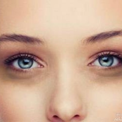 علل کبودی و سیاهی دور چشم و درمان آن
