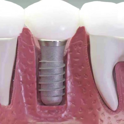 بعد از ایمپلنت دندان کی باید به دکتر مراجعه کرد؟