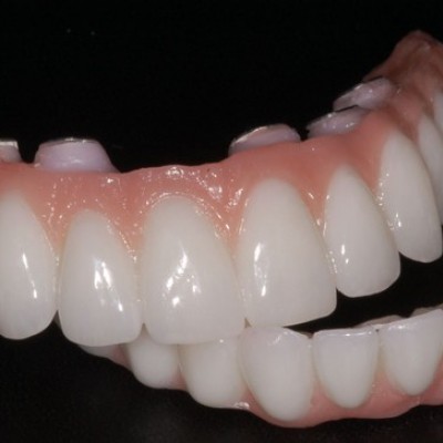 تفاوت ها و شباهت های ایمپلنت دندان ثابت، اوردنچر و دندان مصنوعی متحرک